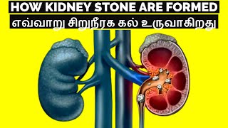 How Kidney Stone are Formed l kidney stone l Tamil [upl. by Teria]