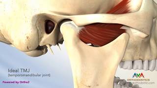 TMJ Disorder or TMD  Clicking and Closed Lock [upl. by Brink]