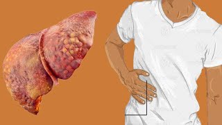 Cirrhosis Of Liver Life Expectancy By Stage [upl. by Tennek]