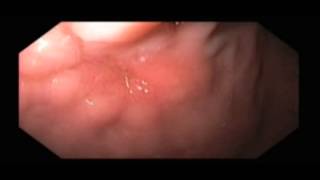 Gastric Ulcer Following Gastrostomy Tube Removal [upl. by Esiuolyram208]