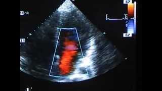 Severe Mitral Valve Prolapse [upl. by Sherlocke]