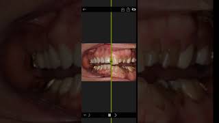 Invisalign Time Lapse Video [upl. by Onitsirc379]