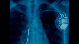 Automatic Implantable CardioverterDefibrillator AICD Explained CureU Healthcare cureuhealthcare [upl. by Hamforrd736]