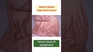 Important Causes of Stretch Marks  Stretch Marks के महत्वपूर्ण कारण stretchmarksinpregnancy skin [upl. by Iralav]