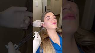 Cheek Filler💉 Dallas surgical Arts 9727764888 Dr Sanovich skincare cheekfiller filler [upl. by Arnuad]