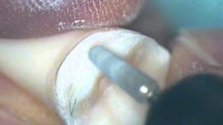 Crown Preparation Tooth Number 30 Part 2 [upl. by Crandall]