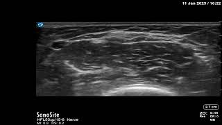 Lateral antebrachial cutaneous nerve  dynamic US scanning [upl. by Notla27]