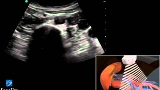 3D Cómo hacer Ecografía de Aorta Abdominal  Ultrasonido SonoSite [upl. by Ahsenaj]