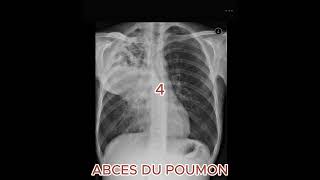 ABCES DU POUMONradiologystudent [upl. by Hnilym744]