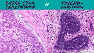 Hair Follicle Tumors vs Basal Cell Carcinoma Made Simple 5Minute Pathology Pearls Dermpath [upl. by Odelet666]