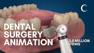 Dental Surgery Animation  Bone Grafting [upl. by Bryon]