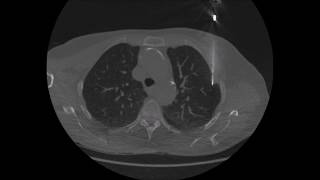 Percutaneous CTguided Lung Biopsy Procedure Technique [upl. by Aleyam119]