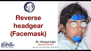 Reverse headgear Facemask step by step by dr ahmed adel orthodontics [upl. by Emmeline]