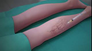 Sclerotherapy Procedure [upl. by Rehpotisrhc]