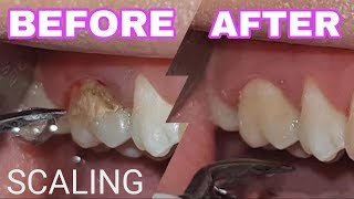 SCALING  Dental Calculus [upl. by Cece]