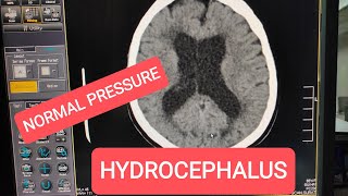 Normal Pressure Hydrocephalus CT Scan Brain [upl. by Eramal]