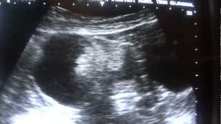 DERMOID CYST ultrasound [upl. by Nesnah]