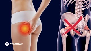 Pain in the butt  Its NOT Piriformis Syndrome [upl. by Everson883]