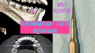 Lingually Positioned Supernumerary Tooth Extraction using Molt Elevator and Periotomes drwahan [upl. by Blas603]