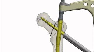 APFN Antirotator Proksimal Femur Çivisi Antirotator Proximal Femoral Nail [upl. by Wind237]