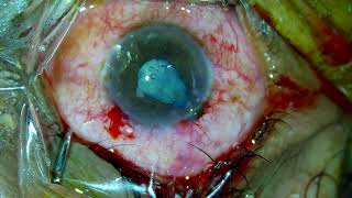 Corneal laceration Repair Traumatic cataract phaco [upl. by Bergwall728]