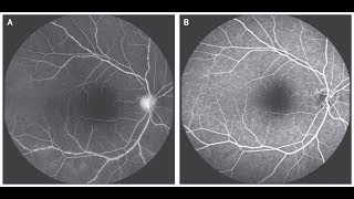 Vaskulitis der Retina bei Takayasu Arteriitis [upl. by Thalia]