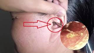 Video ear wax removal is a safe tool Otorhinolaryngology Ear wax blockage removal 5 [upl. by Scandura]