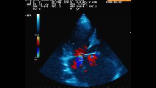 Atrioventricular septal defect AVSD [upl. by Emma]