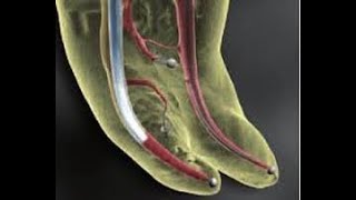 Root canal obturation 1 dr mazen doumani [upl. by Mur]