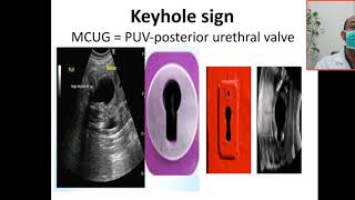 Case 188 posterior urethral valve obstructive uropathy keyhole sign in MCUG renal dysplasia VUR [upl. by Remle]