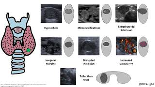 Thyroid Nodules [upl. by Attinahs]