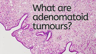 What are Adenomatoid Tumours  Pathology mini tutorial [upl. by Curley]