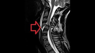 Stem cell therapy for spinal cord injury [upl. by Eidnalem]