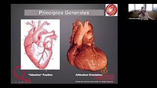 EXTRASÍSTOLES VENTRICULARES LOCALIZACIÓN MEDIANTE ECG DE SUPERFICIE PREPARANDO LA ABLACIÓN [upl. by Muryh]