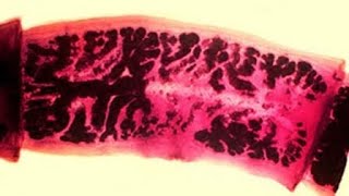 Cysticercosis of the Humanoid Nervous System [upl. by Enoyrt704]