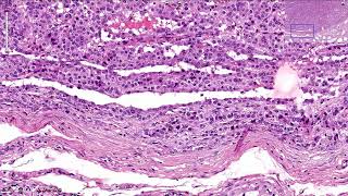 Leydig Cell Tumor  Ovary Histopathology [upl. by Boesch]