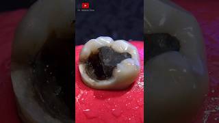 Indirect dental restoration satisfying [upl. by Tirb434]