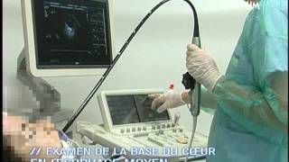 Echographie TransOesophagienne ETO  Film de formation [upl. by Eidac]