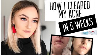 HOW I CLEARED MY ACNE IN 5 WEEKS  Rhiannon Mair [upl. by Nichol608]