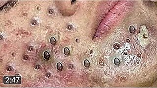 𝗘𝘅𝘁𝗿𝗲𝗺𝗲 𝗕𝗹𝗮𝗰𝗸𝗵𝗲𝗮𝗱 𝗥𝗲𝗺𝗼𝘃𝗮𝗹 325 blackheads acne popping pimple SacDepSpa [upl. by Nangatrad]