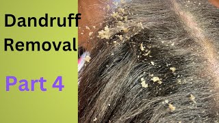 Dandruff Removal Part 4  Huge Flakes [upl. by Teplitz]