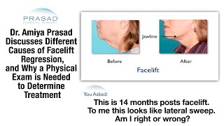 How to Determine Lateral Sweep and Other Facelift Recovery Problems with a Physical Examination [upl. by Gwenette]