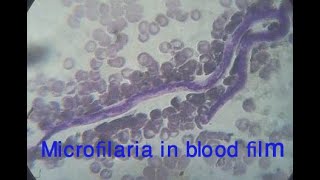 Live microfilaria in chylous urine human [upl. by Asseral]