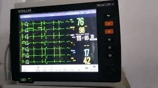 case of Ventricular Bigeminy changing to Trigeminy and Quadrigeminy [upl. by Pinto]