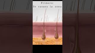Depilación Laser Cómo actúa en la piel [upl. by Ajar996]