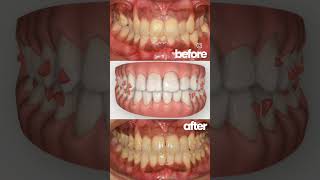 Severe Crowding correction with invisalign invisalignbeforeandafter invisaligntreatment [upl. by Ttenaj228]