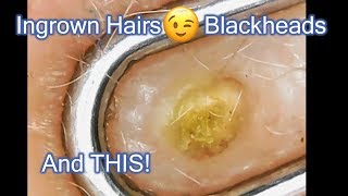 An Awesome Compilation Ingrown Hairs Blackheads and Whiteheads Whats your favorite [upl. by Won998]