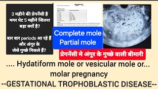 Molar pregnancy  Hydatiform mole kya होती है प्रेगनेंसी में अंगूर के गुच्छे वाली बीमारी GTD [upl. by Acinoev]