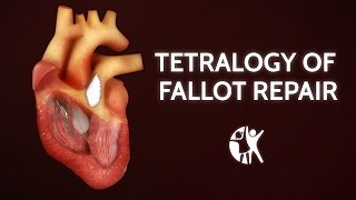 Tetralogy of Fallot Repair  Cincinnati Childrens [upl. by Valleau]