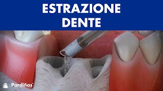 Estrazione dente – Conservazione del alveolo © [upl. by Orman]